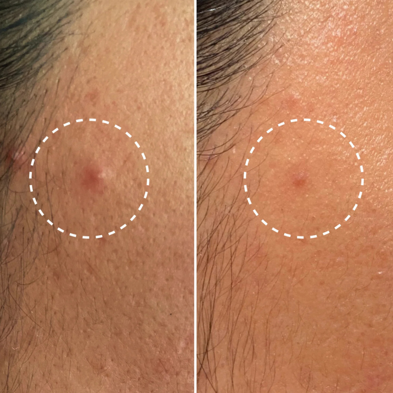 Miracle Pimple Patch