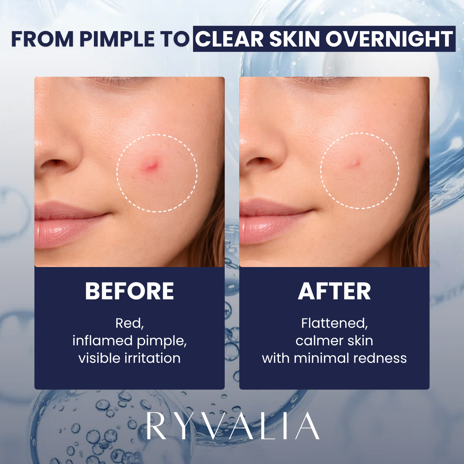 Miracle Pimple Patch